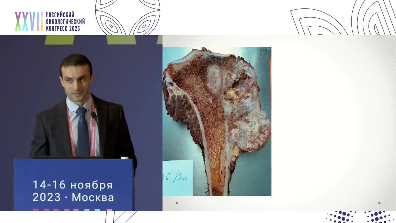 Биопсия сарком: пункционная или открытая