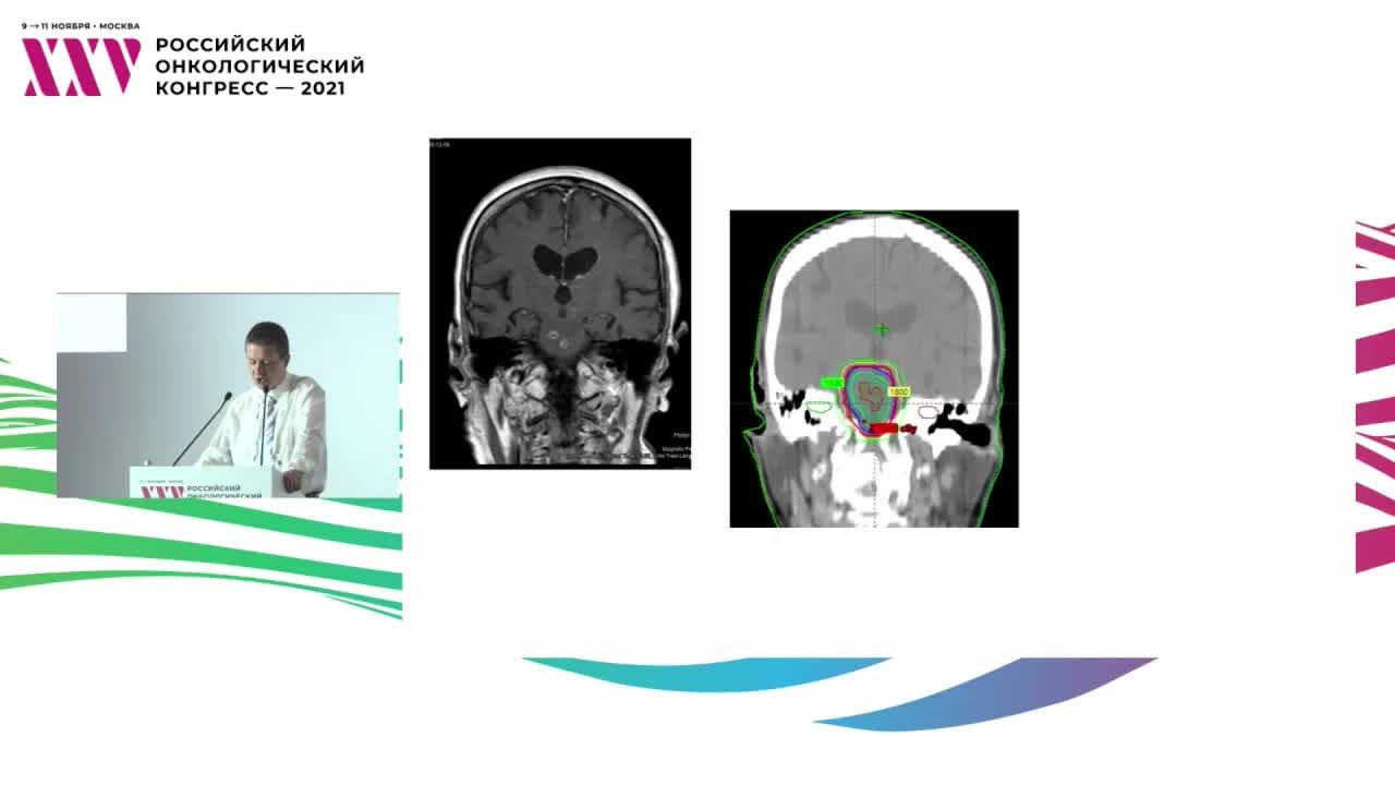 Лечение метастазов в головном мозге у больных EGFR/ALK/PD-L1 позитивным раком легкого: облучать или нет до начала иммунотерапии? Нет – радиотерапевт