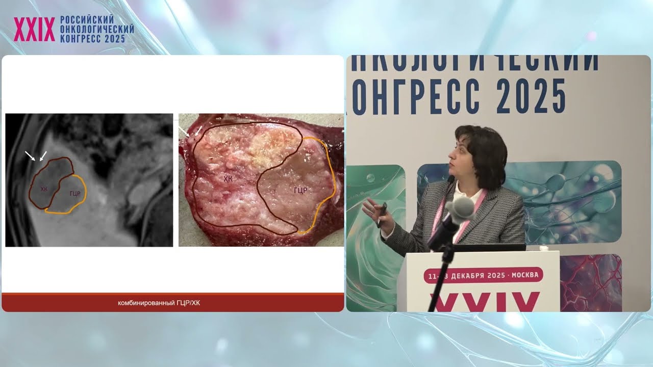 Радиомика в диагностике первичных опухолей печени