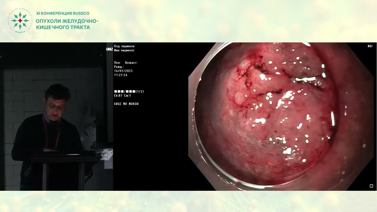 Случай эндоскопического лечения раннего рака желудка