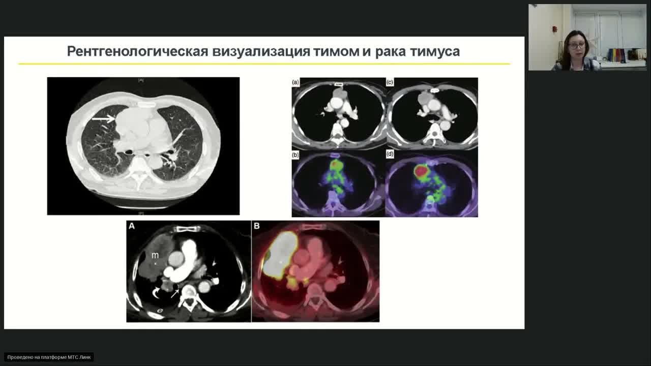 редкие опухоли. Тимома и рак тимуса (вебинар 26 января 2024)