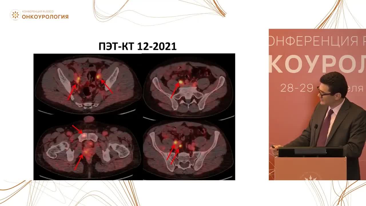 Гормонально-чувствительный РПЖ. Клинический случай 1