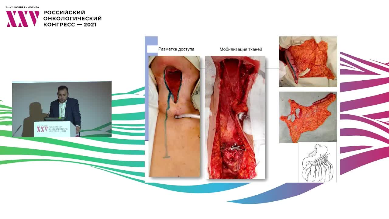 Реконструкция сложных мягкотканных и комбинированных дефектов при раке слизистой оболочки полости рта