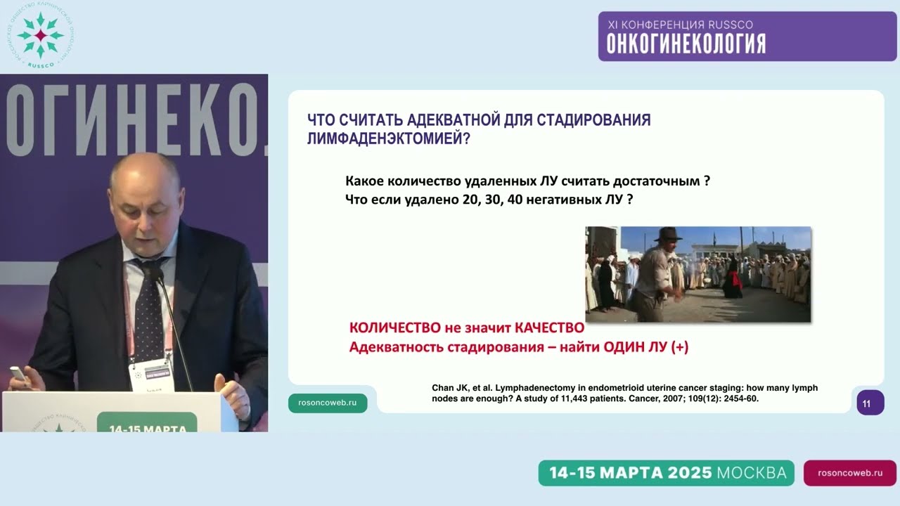  БСЛУ или лимфаденэктомия? БСЛУ – стандартная процедура при раке эндометрия