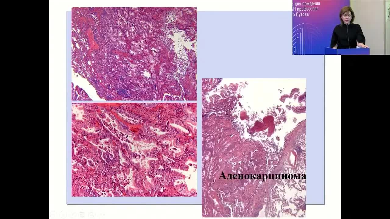 Кистозные варианты рака легкого