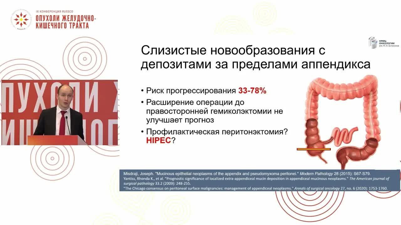 Резектабельный рак аппендикса – выбор объема хирургии