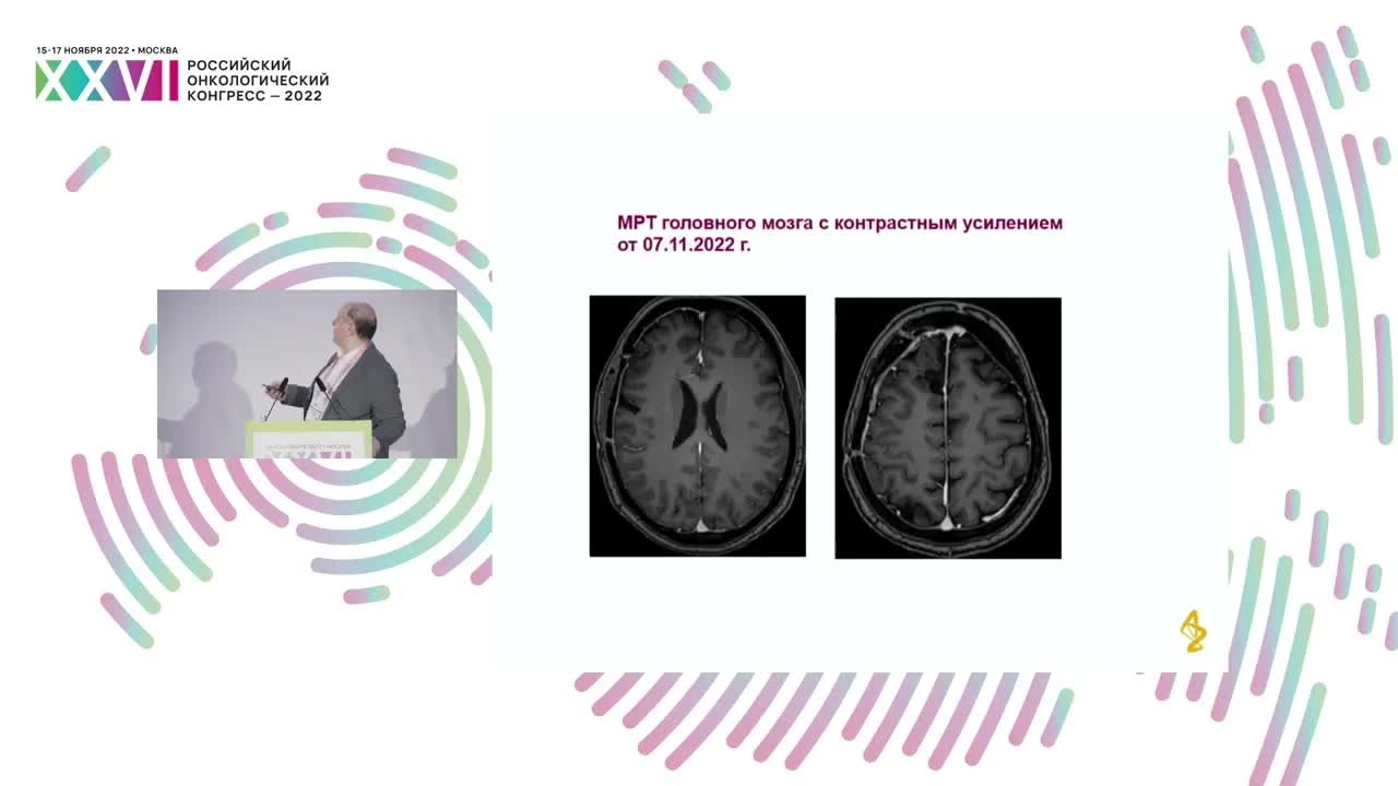 Меланома с метастазами в головной мозг – расширяющиеся возможности системного лечения