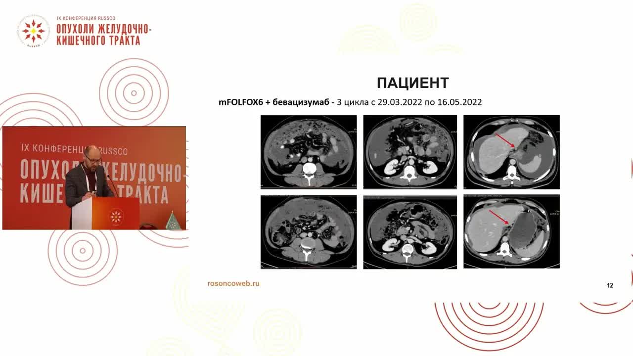 Разбор клинических наблюдений: рак тонкой кишки