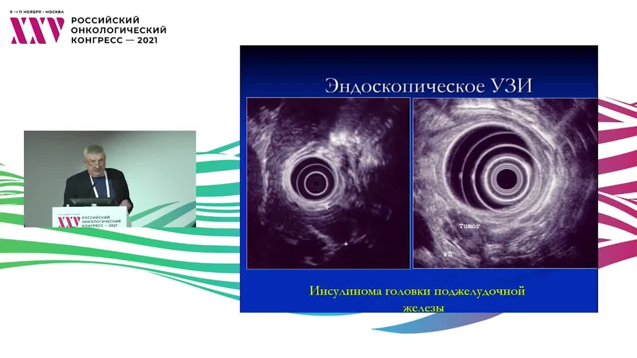 Гормонально-активные опухоли поджелудочной железы