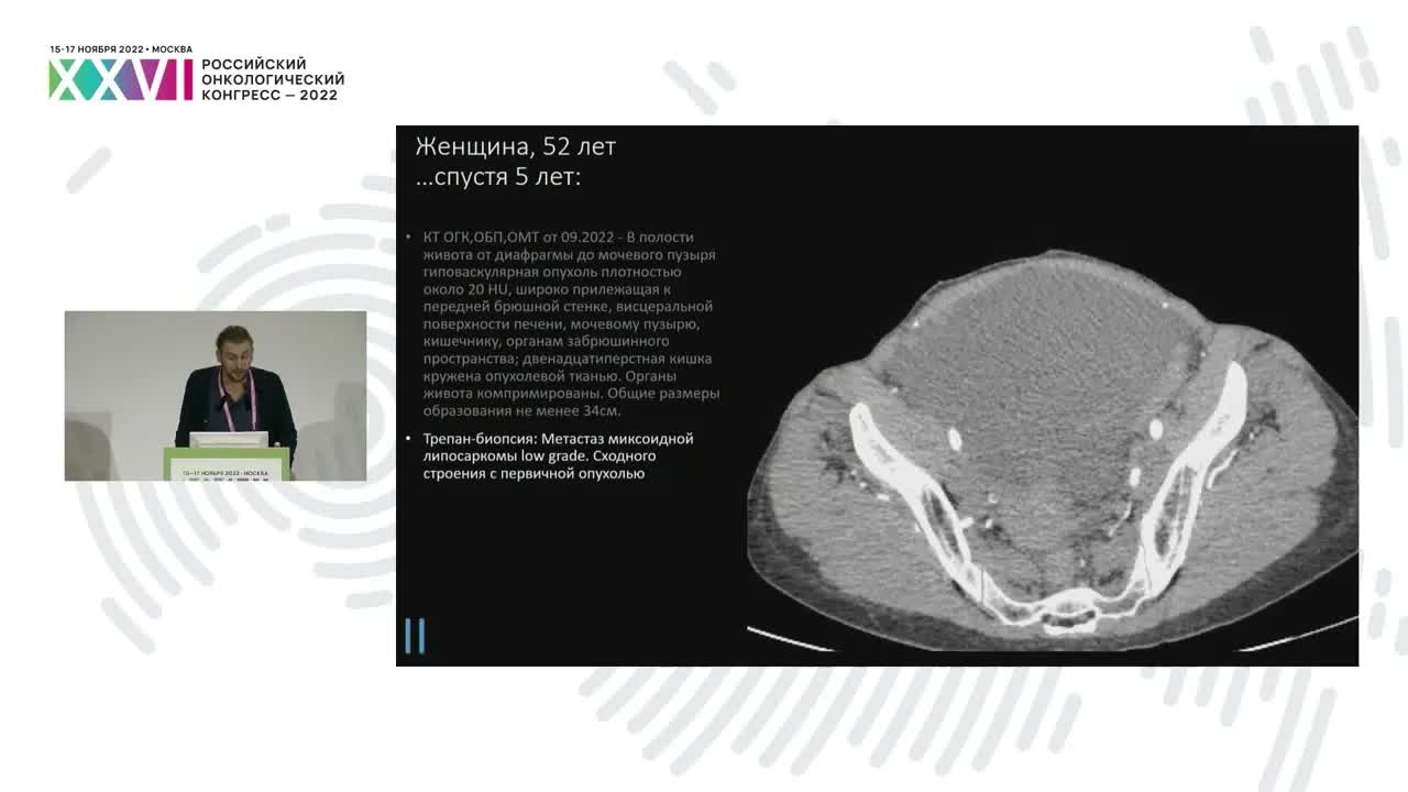 Новые подходы в комбинированной конечность-сохраняющей терапии сарком мягких тканей