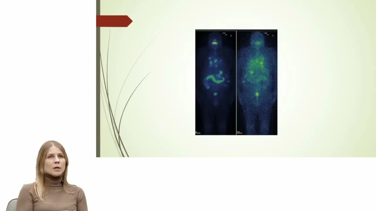 Рак щитовидной железы: вопросы из реальной клинической практики (вебинар 13 февраля 2024)