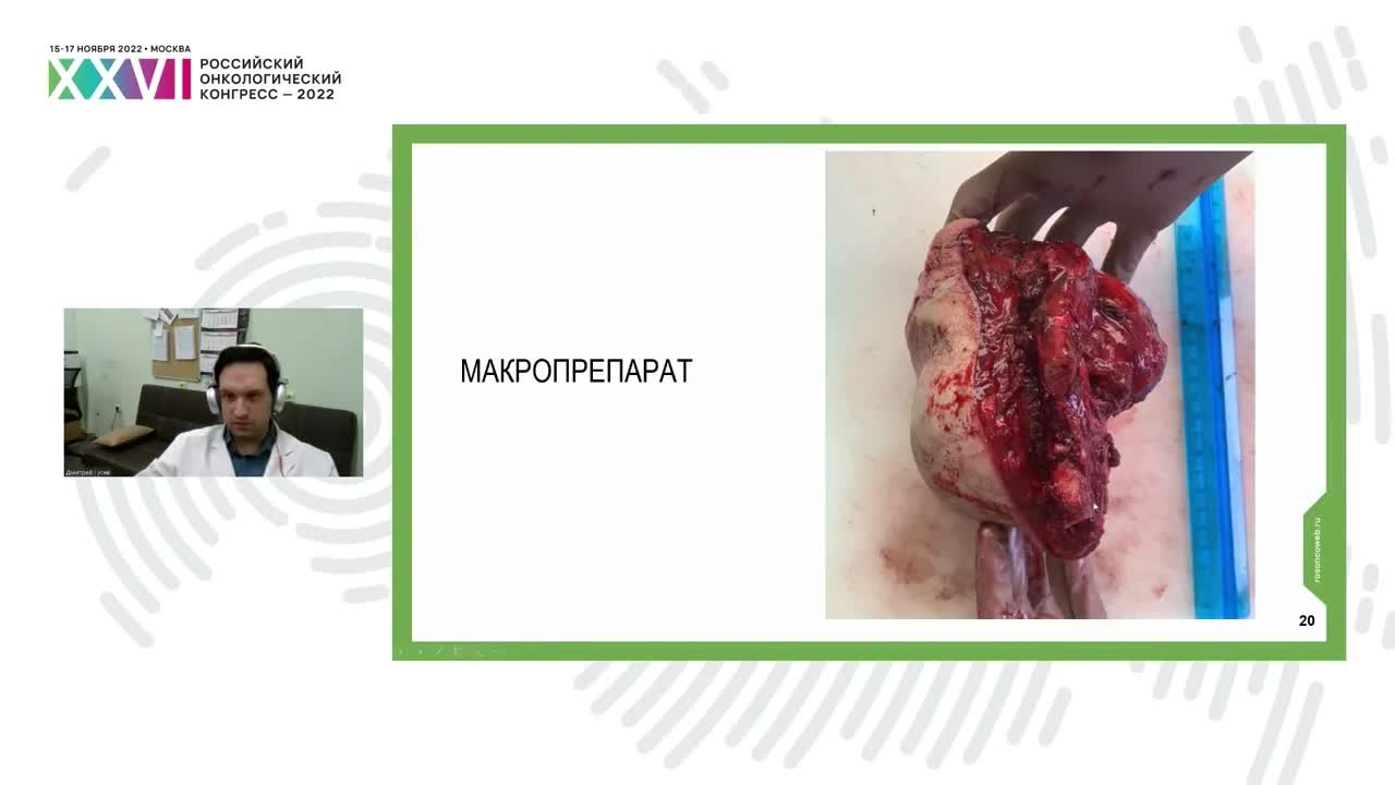 Клинический случай: саркома кости