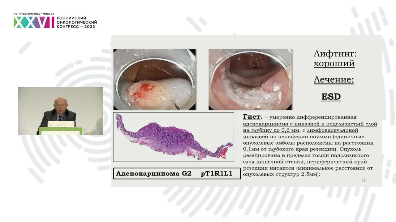 Стандарты эндоскопического удаления раннего рака толстой кишки