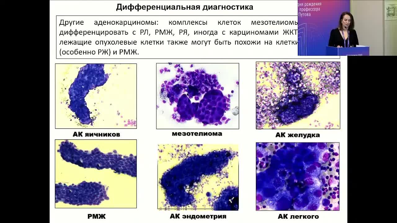 Морфологические и молекулярно-генетические подходы в диагностике опухолей легкого. Кл. случай 1