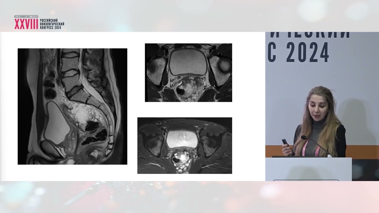 Циторедукция «вне закона». Колоректальный рак с dMMR