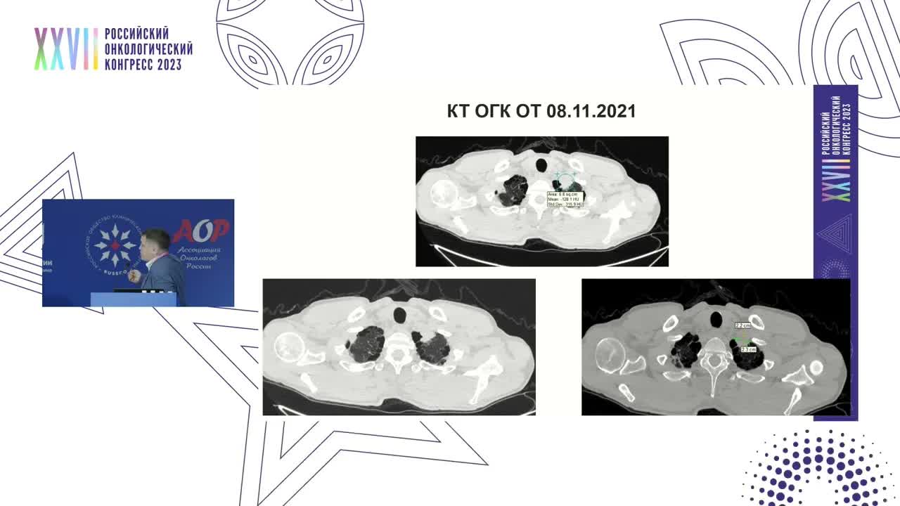 Диагностические ловушки. Редкая форма рака легкого. Онколог