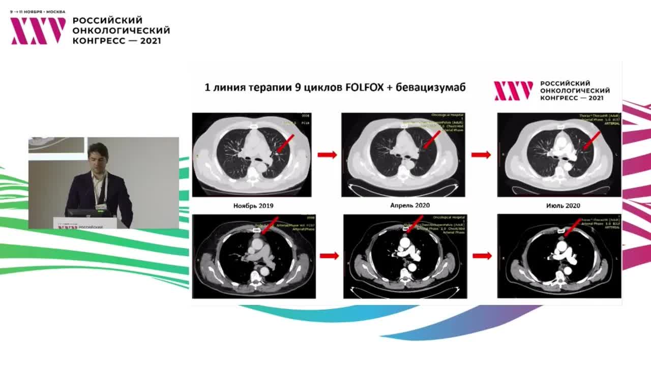 Выбор оптимальной последовательности режимов системного лечения колоректального рака. Кл.случай 1