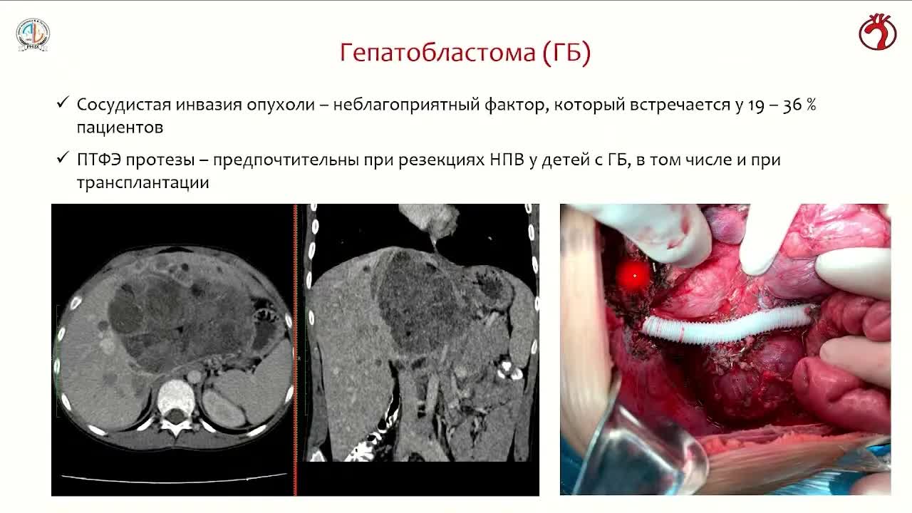  Опыт совместных онкокардиохирургических вмешательств при опухолевых тромбах правых отделов сердца