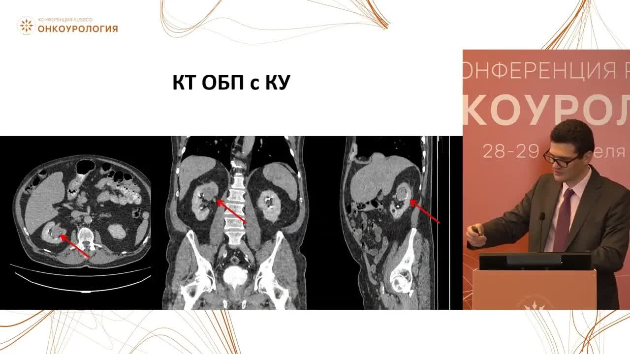 Гормонально-чувствительный РПЖ. Клинический случай 2