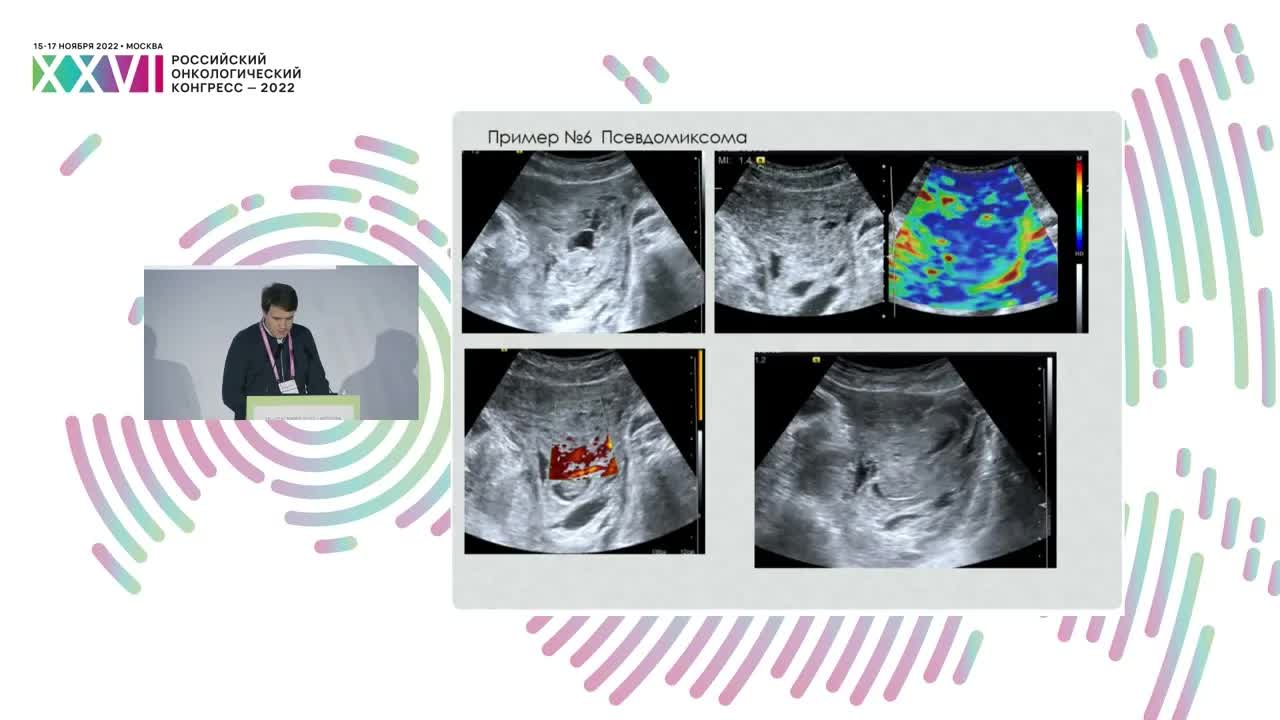 УЗ-визуализация и core-biopsy под УЗ-навигацией забрюшинных неорганных сарком