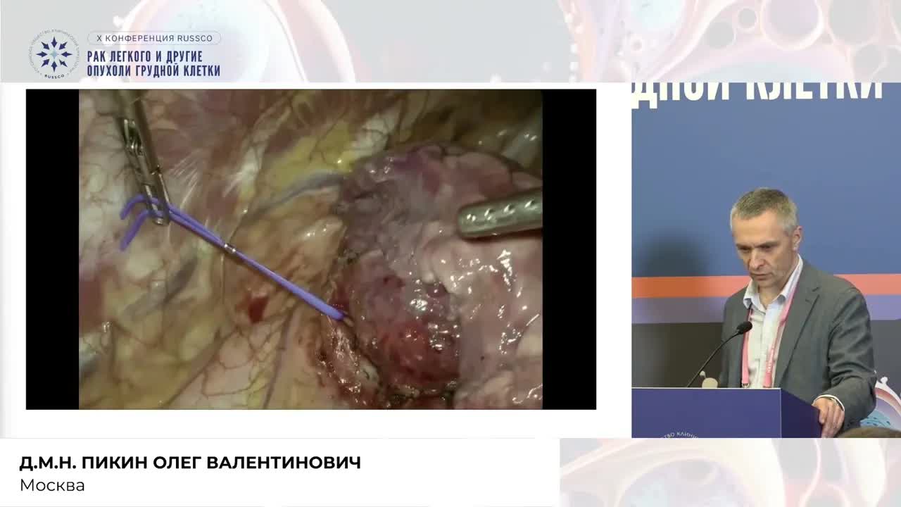 Торакоскопические изолированные резекции бронхов при нейроэндокринных опухолях