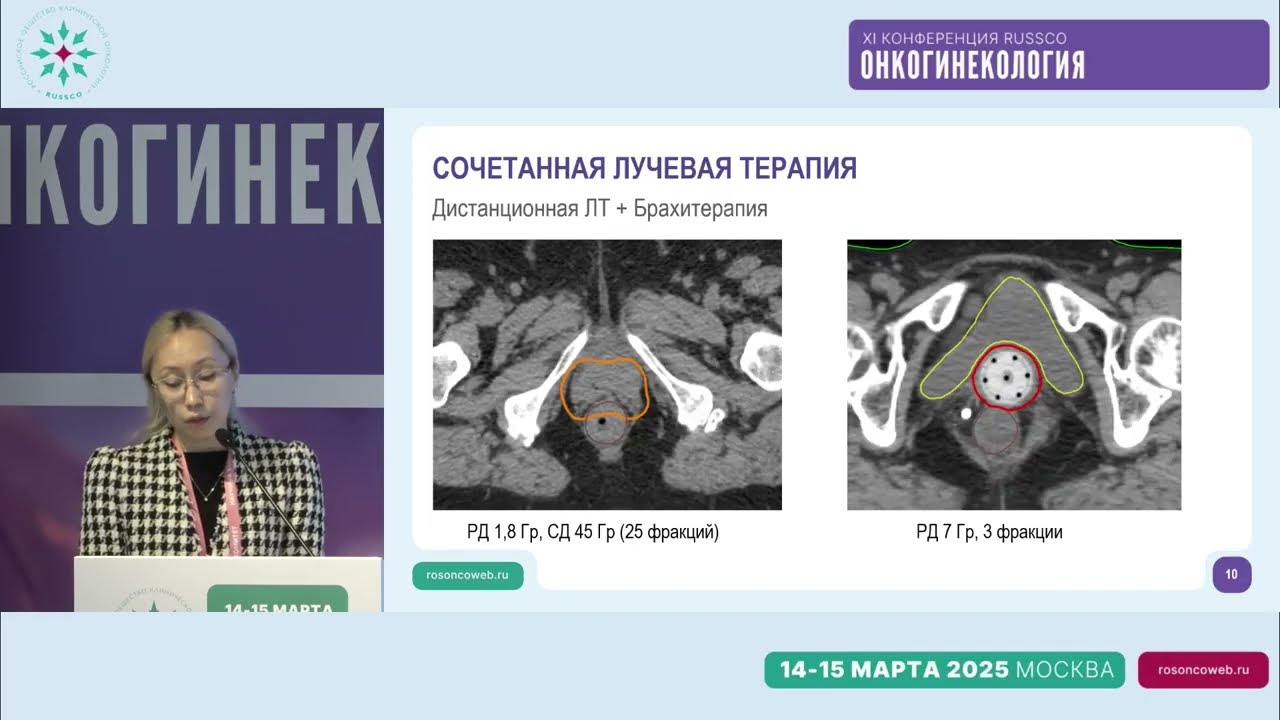 Адъювантная терапия при раке тела матки II стадии