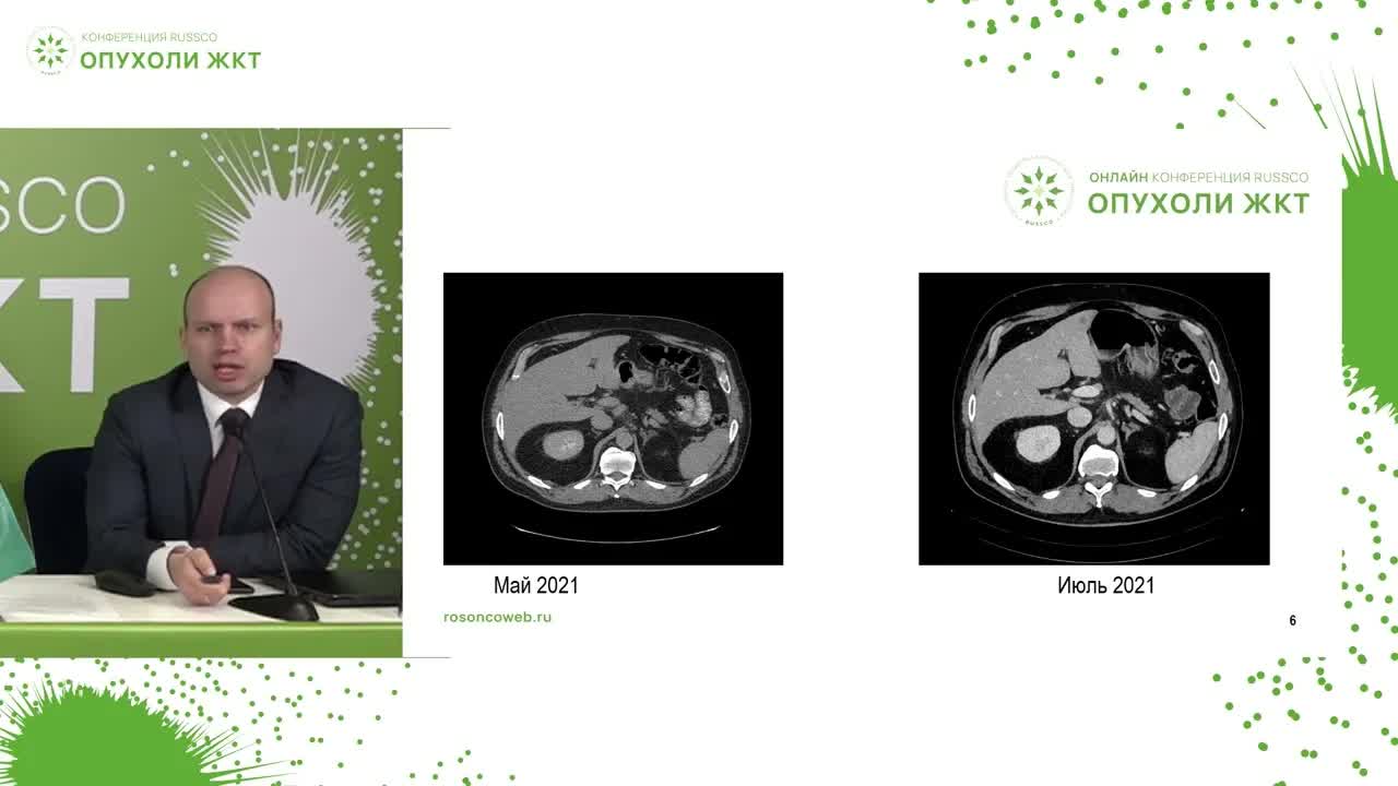 Разбор клинических наблюдений: рак поджелудочной железы