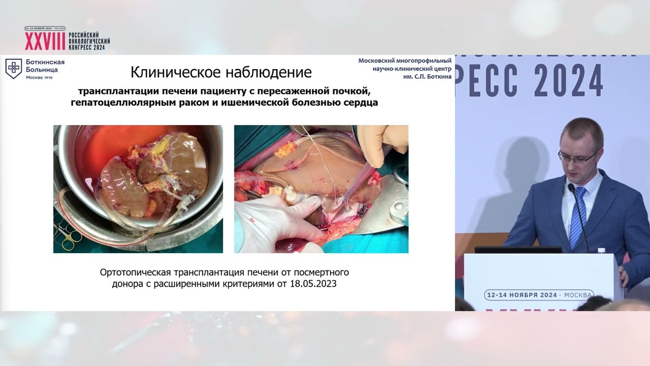 Лечение больных первичным раком печени в условиях нового стандарта оказания онкопомощи в Москве