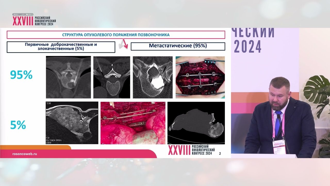 Хирургическое лечение пациентов с метастатическим поражением позвоночника