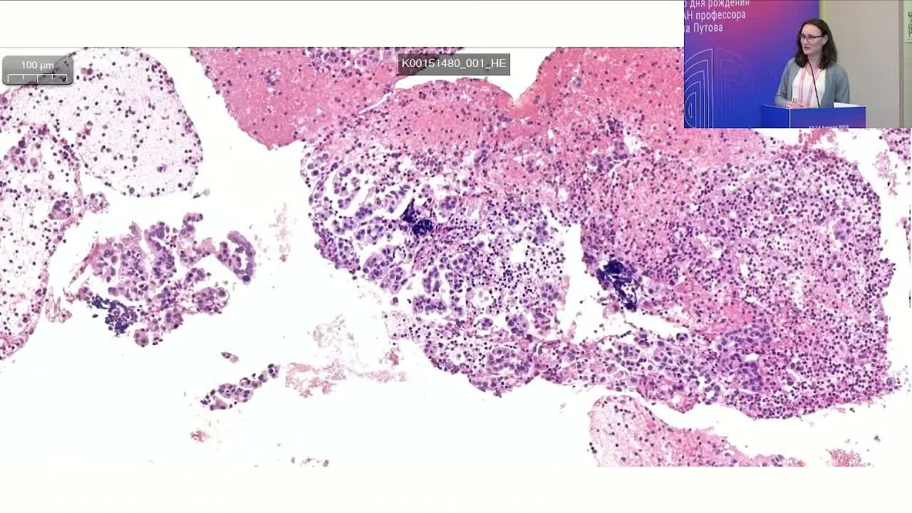 Морфологические и молекулярно-генетические подходы в диагностике опухолей легкого. Кл. случай 2