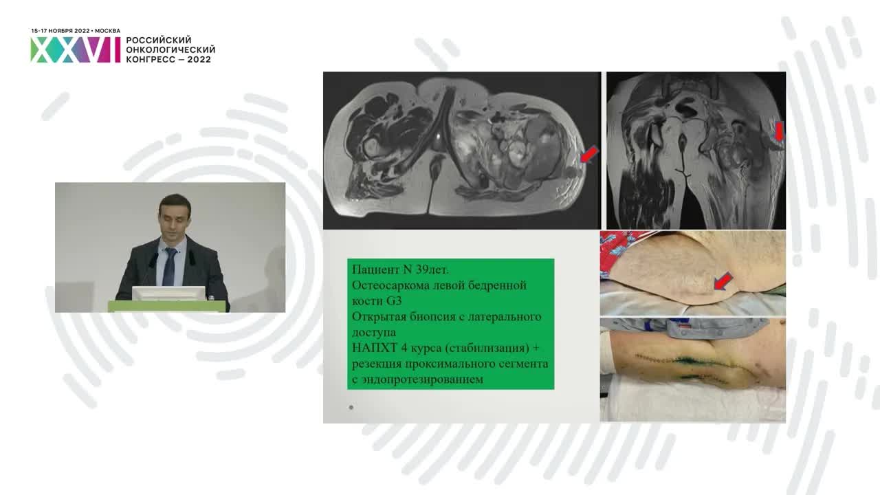 Когда сложно поставить диагноз. Биопсии сарком (принципы и подводные камни)