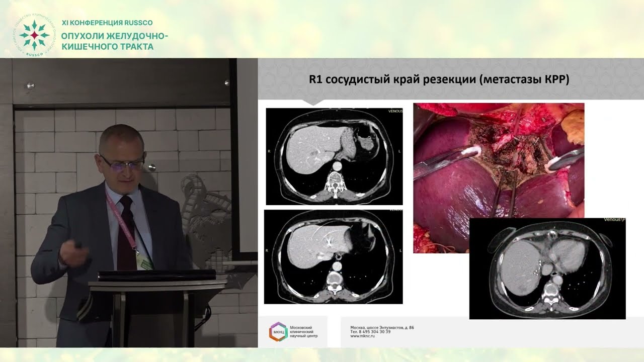 Обширные и мультифокальные резекции печени. Преимущества и недостатки
