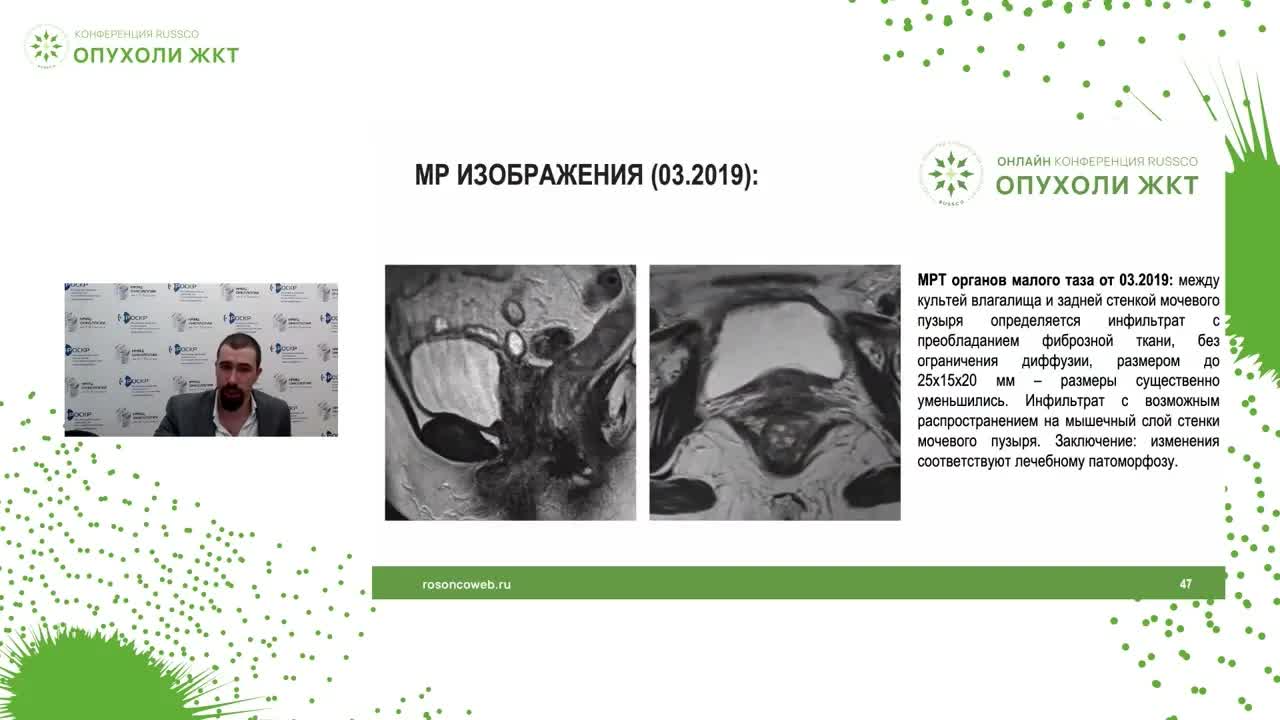 Хирургия рака прямой кишки. Клинический случай 2