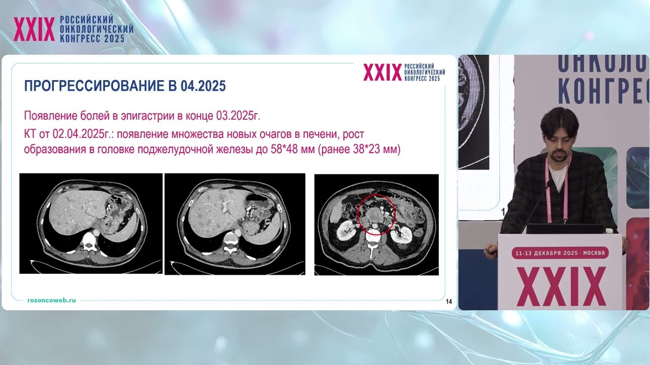  Мутация ATM и длительный ответ на PARP-ингибиторы при раке поджелудочной железы