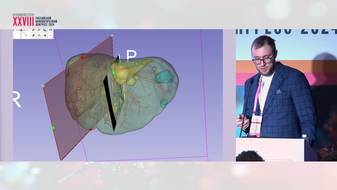 Методы планирования и интраоперационной навигации в хирургии колоректальных метастазов в печени