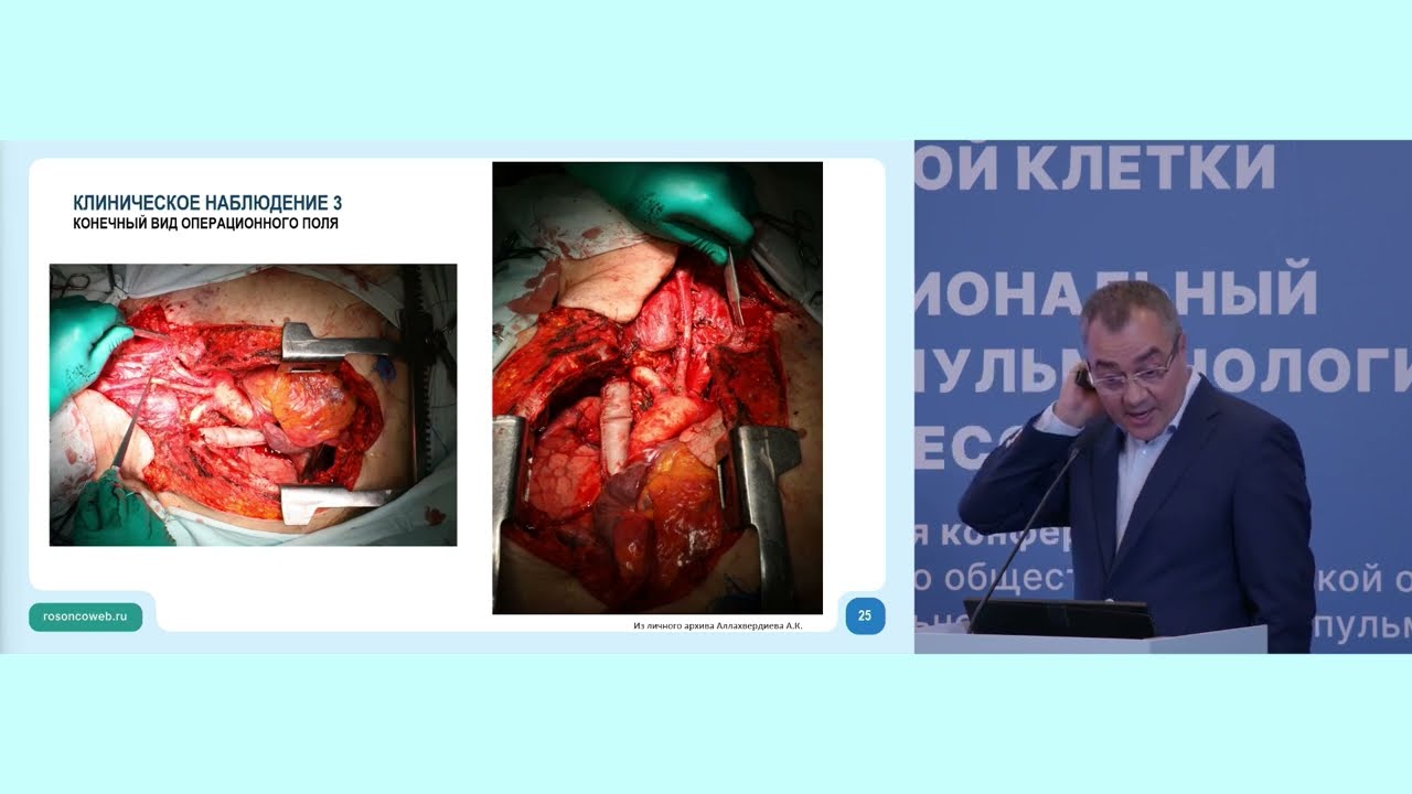 Опухоли средостения: от простого к сложному