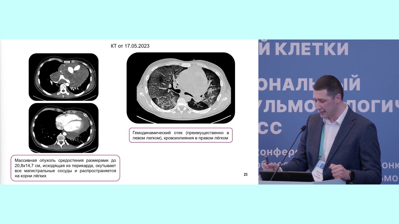 Первичные и метастатические опухоли сердца