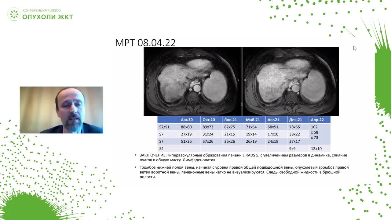 Разбор клинических наблюдений: гепатоцеллюлярный рак