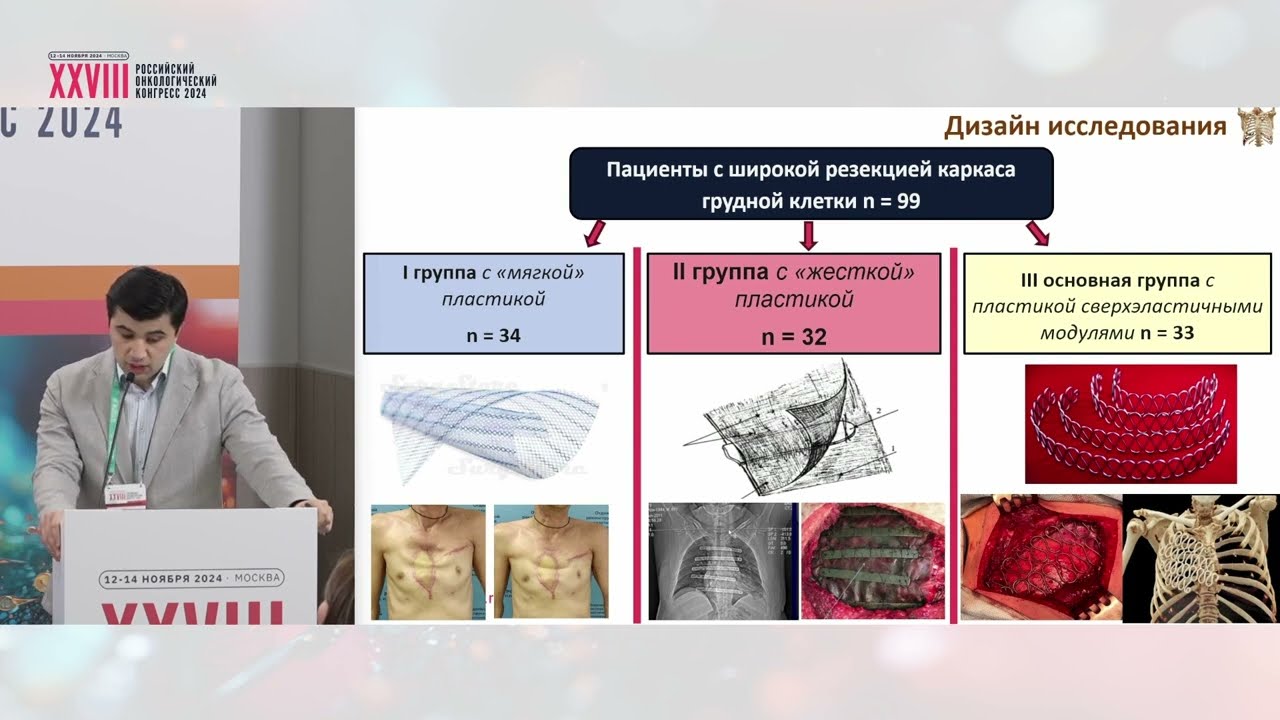 Реконструкция пострезекционных дефектов каркаса грудной клетки модулями из никелида титана