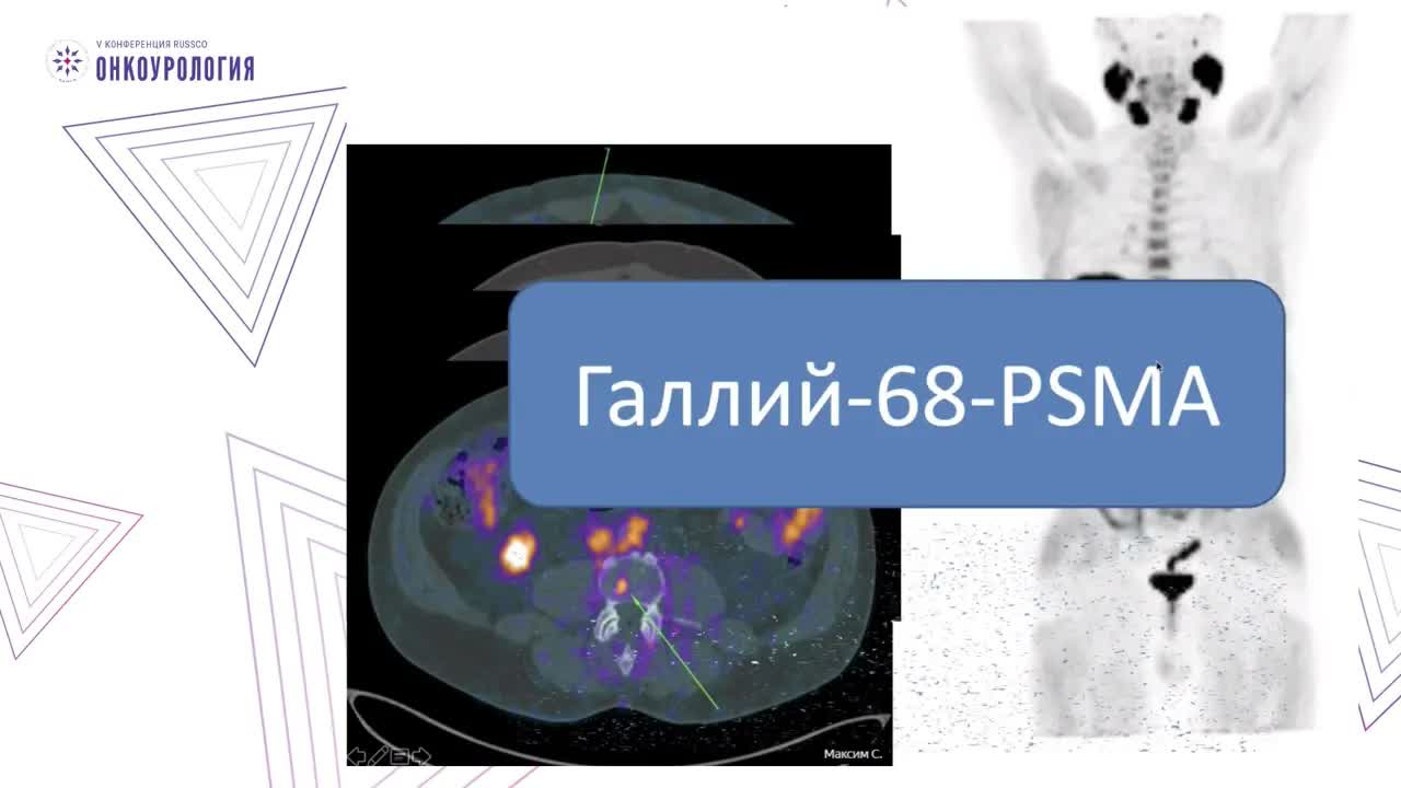 Роль разных диагностических методов при олигометастатическом раке предстательной железы