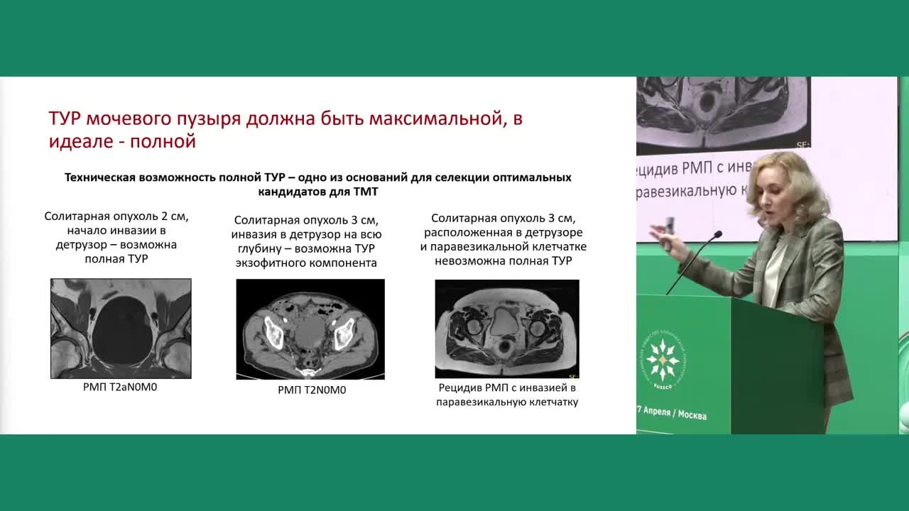 Неметастатический мышечно-инвазивный рак мочевого пузыря: обзор существующих опций