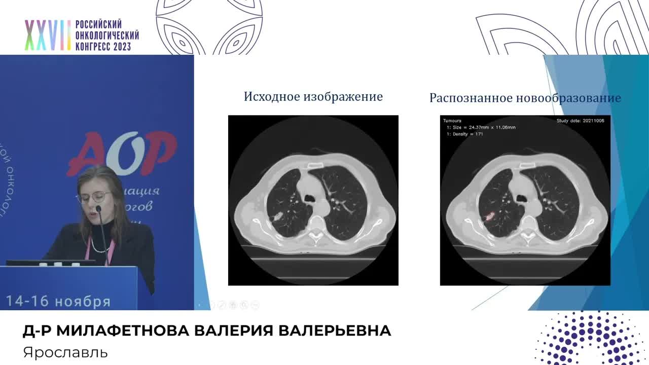 Компьютерный экспресс-метод оценки динамики ответа опухолевого процесса по RECIST критериям