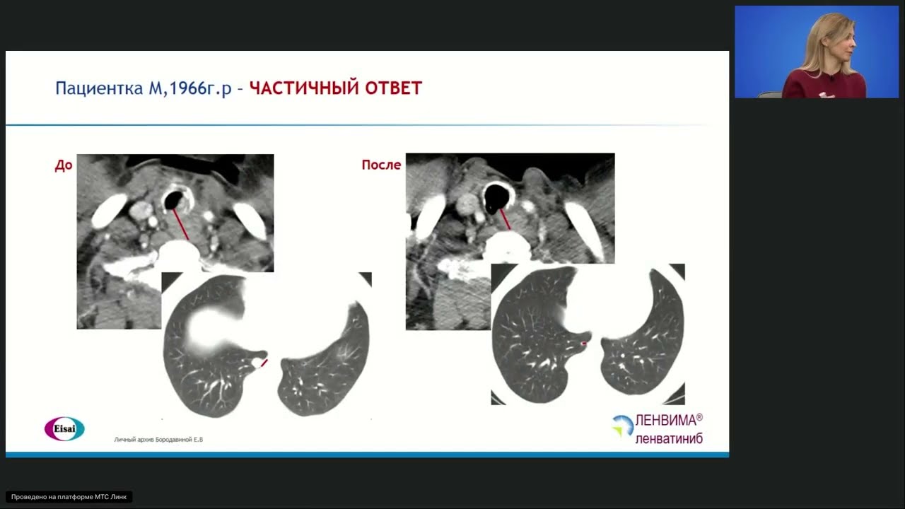 Дифференцированный рак щитовидной железы: вопросы из клинической практики (вебинар 4 февраля 2026)