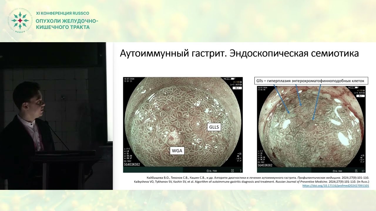 Случай эндоскопического лечения раннего рака желудка на фоне аутоиммунного гастрита