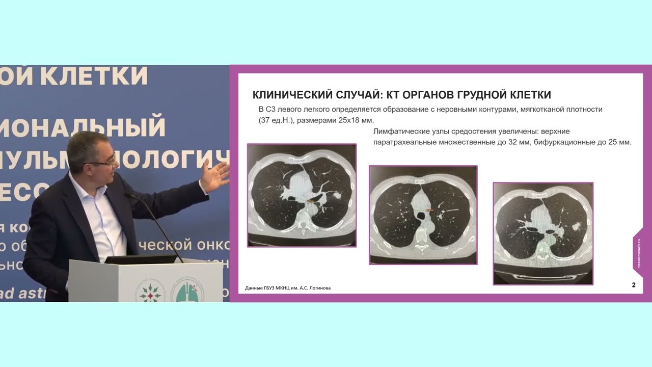 Разбор клинических случаев по раку легкого. Дискуссия с хирургом