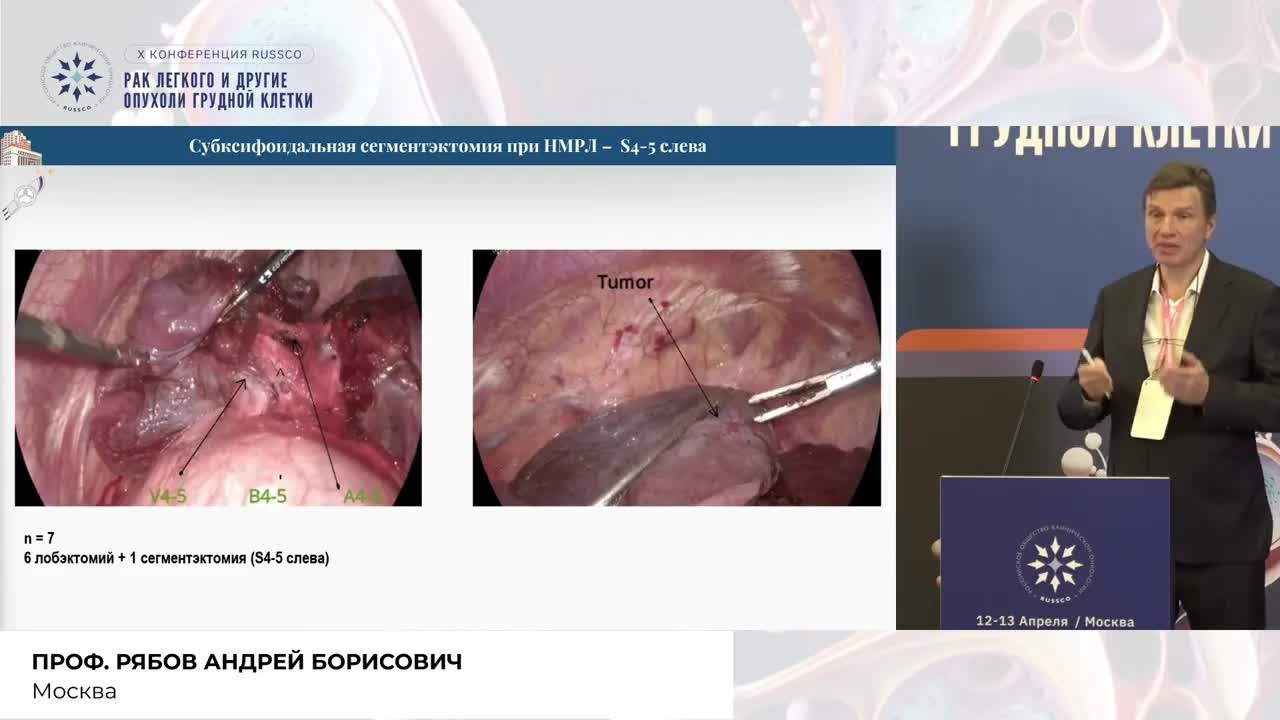 Эволюция доступа в хирургии рака легкого