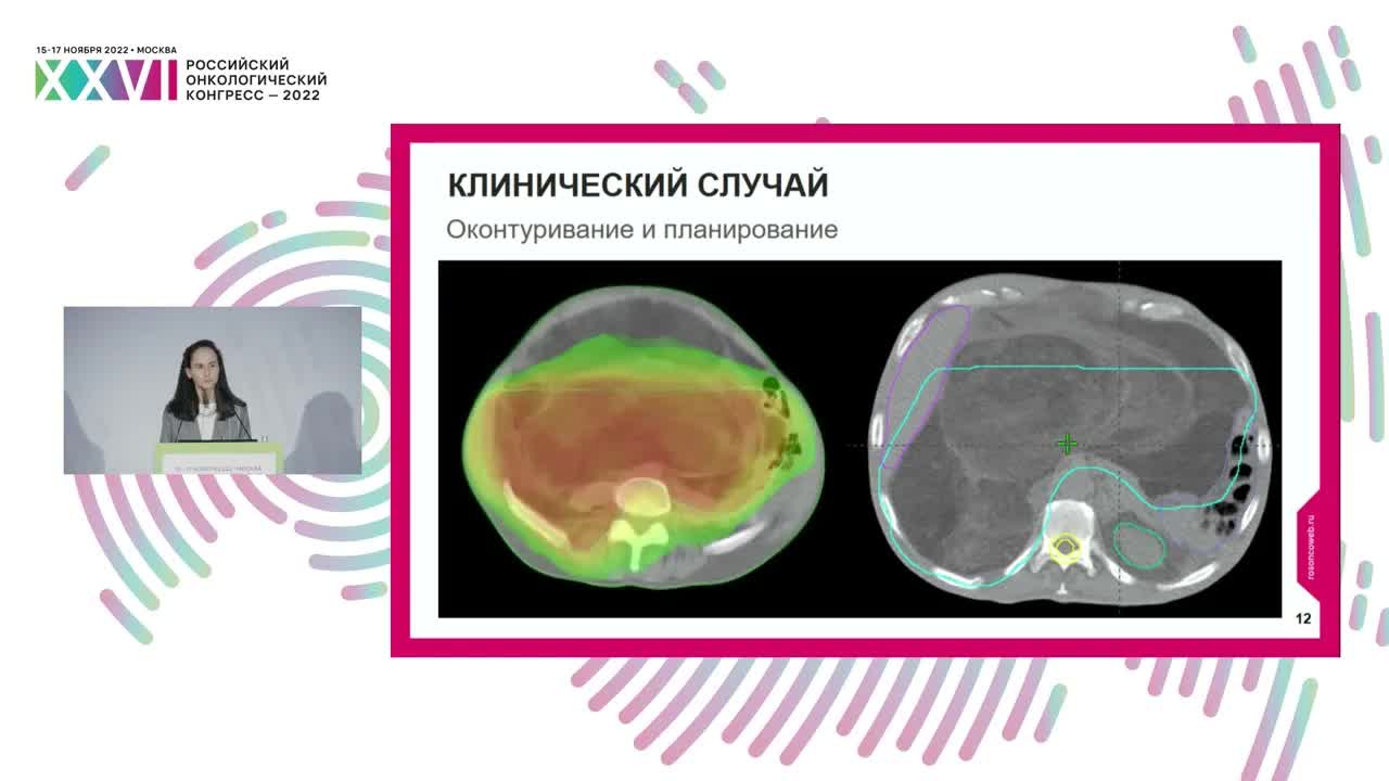 Предоперационная ЛТ с последующей операцией у больного гигантской первичной G1 забрюшинной саркомой