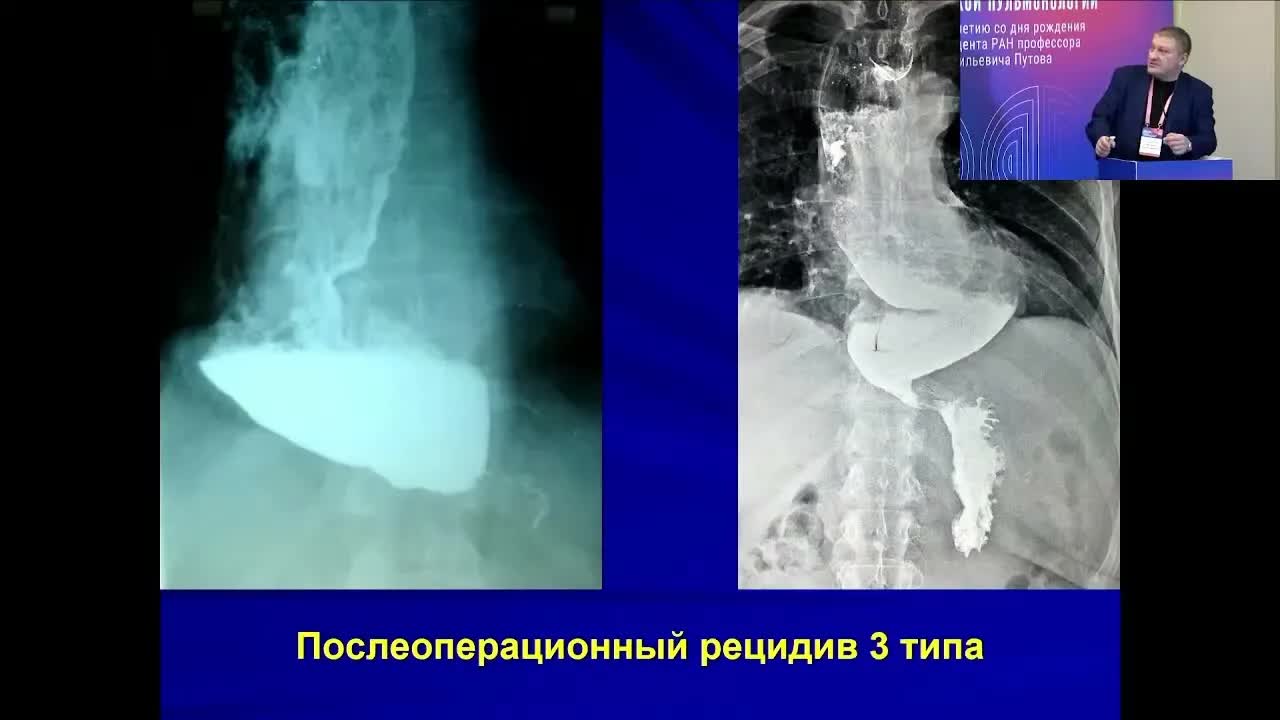 Малоинвазивное лечение ахалазии кардии: лапароскопия или пероральная эзофагомиотомия