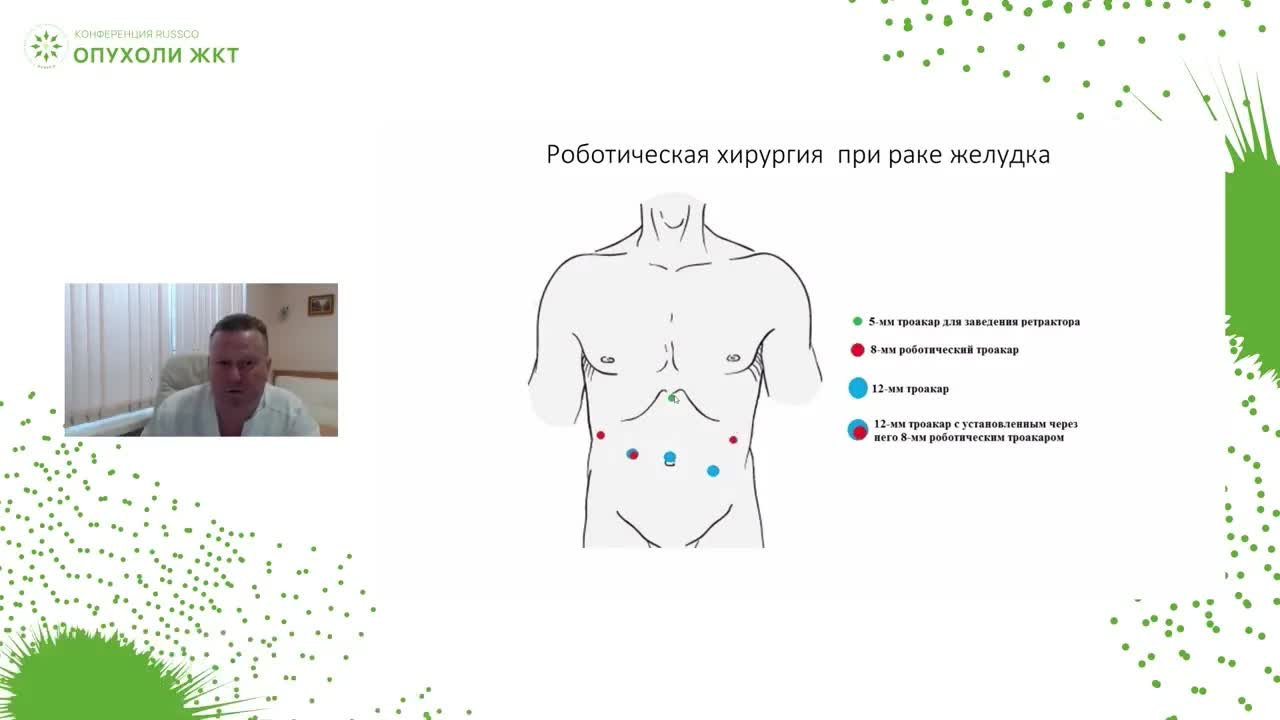 Робот-ассистированная хирургия рака желудка