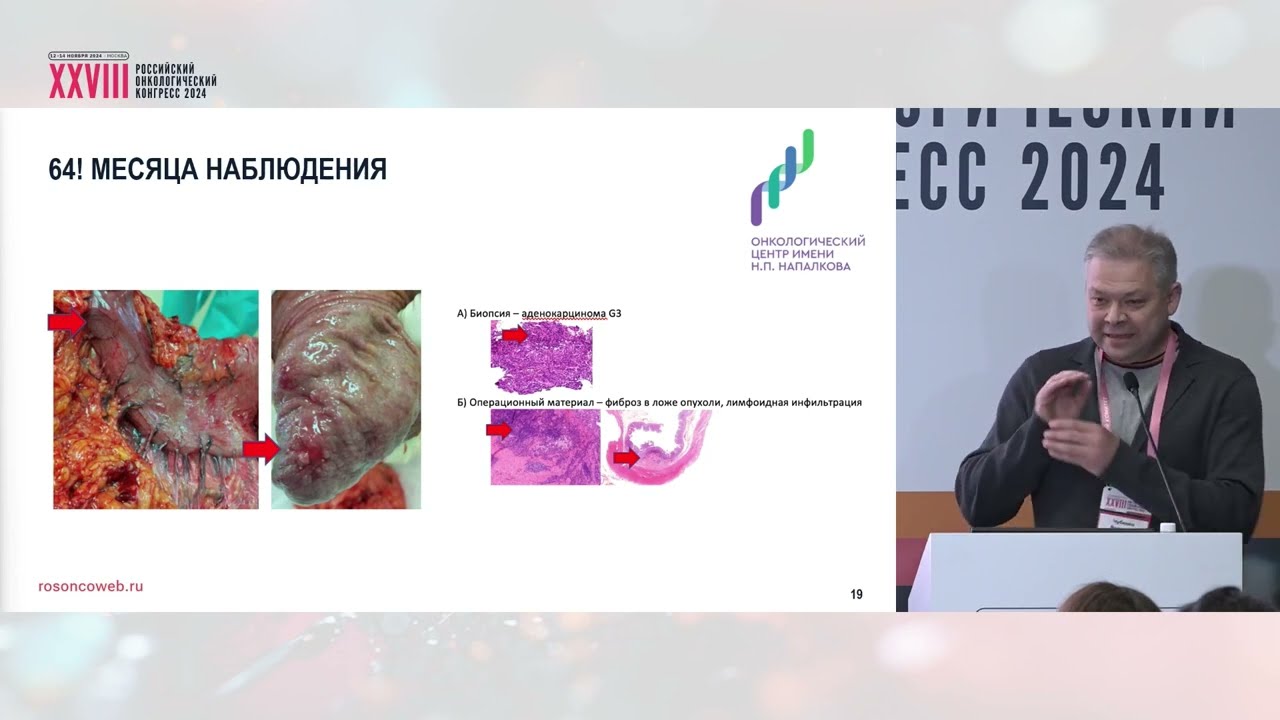 Неоадъювантная иммунотерапия при MSI раке желудка